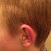 Foam ear plug in ear